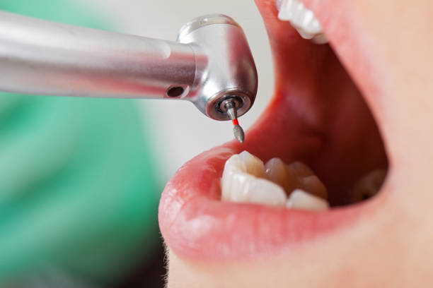 Best Emergency Wisdom Teeth Removal in Woodstock, GA